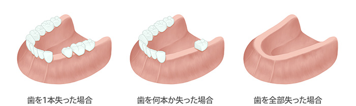 歯を失った場合