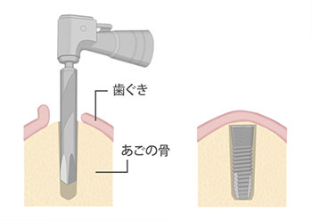 インプラントの埋入