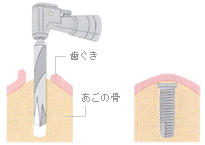インプラント埋め込み