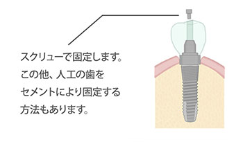 スクリューで固定