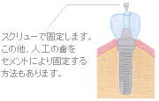 スクリューで固定