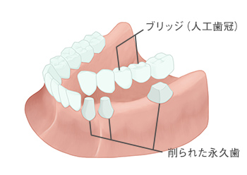 ブリッジ