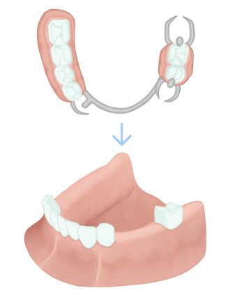 部分入れ歯