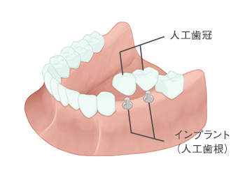 ブリッジ