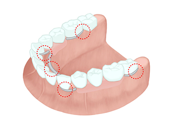 部分入れ歯の問題点