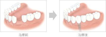 １本の歯が欠けている場合