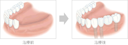 １本の歯が欠けている場合