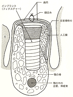骨誘導再生法
