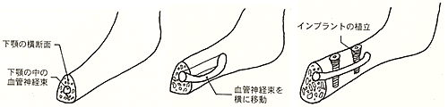 下歯槽管側方移動術